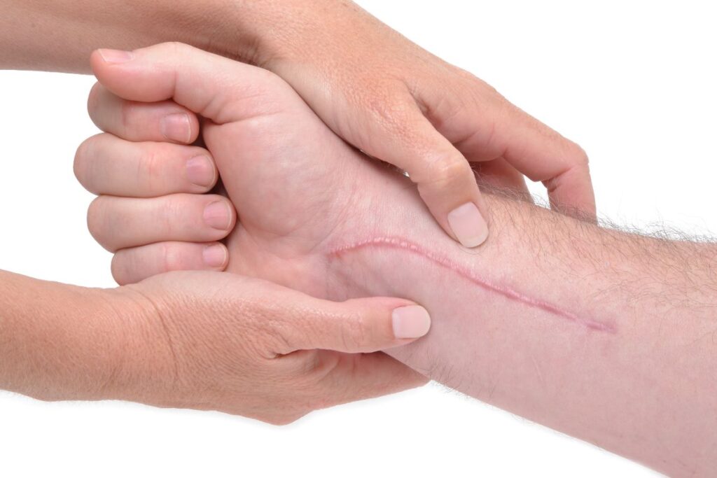 Cómo prevenir y tratar las cicatrices: una guía completa
