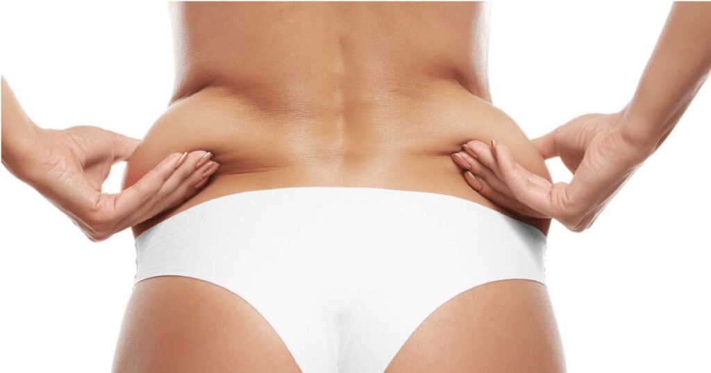 ¿Es la liposucción la solución para ti?