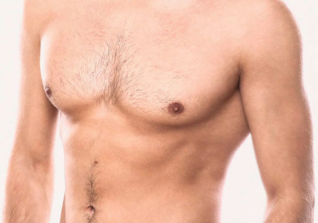 Reducción mamaria masculina: solución para la ginecomastia